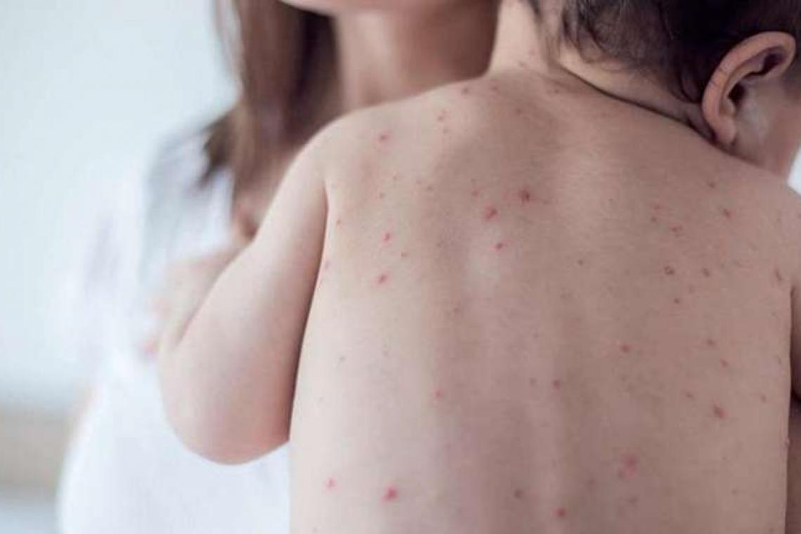 La provincia informó que argentina está en alerta por casos de sarampión