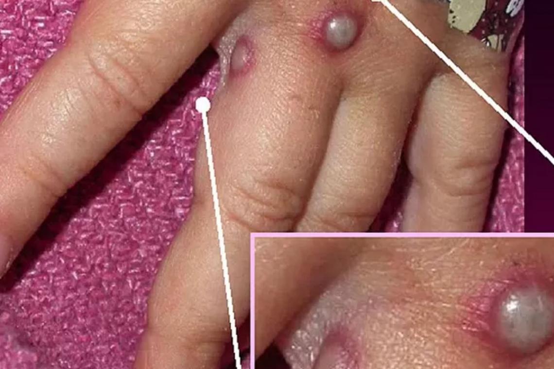 Viruela del mono: ¿puede convertirse en pandemia? (y otras 3 incógnitas sobre esta enfermedad)