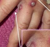 Viruela del mono: ¿puede convertirse en pandemia? (y otras 3 incógnitas sobre esta enfermedad)