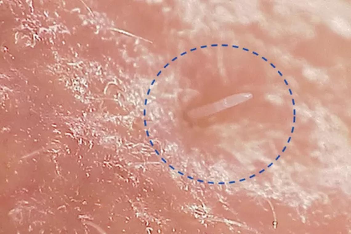 El problema de los diminutos ácaros que tienen sexo en nuestras caras