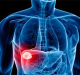 HEPATITIS C: EN LA ACTUALIDAD SOLO UN BAJO NÚMERO DE PACIENTES ES DIAGNOSTICADO EN AMÉRICA LATINA