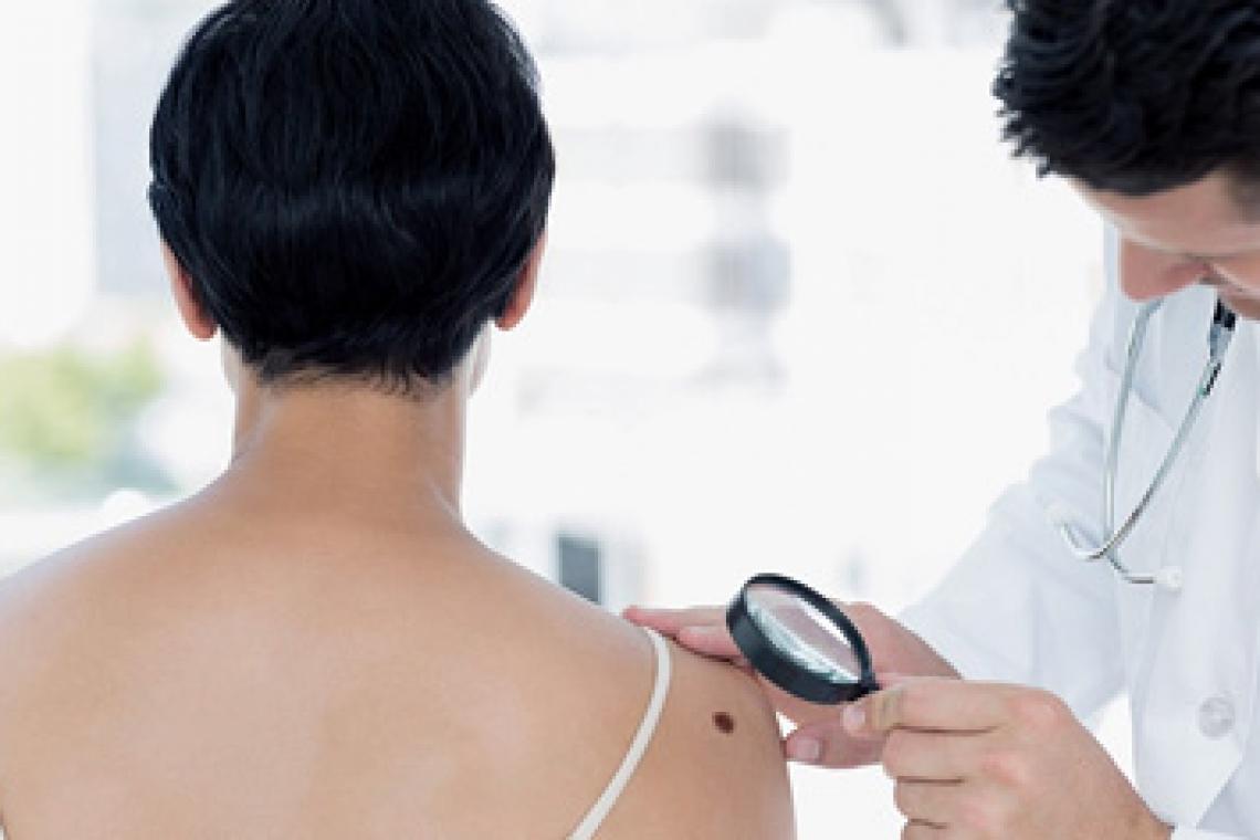 Llega el verano y aumenta la exposición al sol, ¿qué tipo de lunares hay que vigilar?